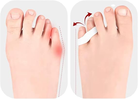 Ayak Serçe Parmak Duruş Düzeltİci, Sürtünme ve Yana Batmayı Engelleyici, Silikon Bunyon Aparat, Yastıklama, Unisex, Yan Parmağa Ğeçmeli/Geçmesiz Seçenekli (1 Çift) (Yan Parmak GEÇMELİ)